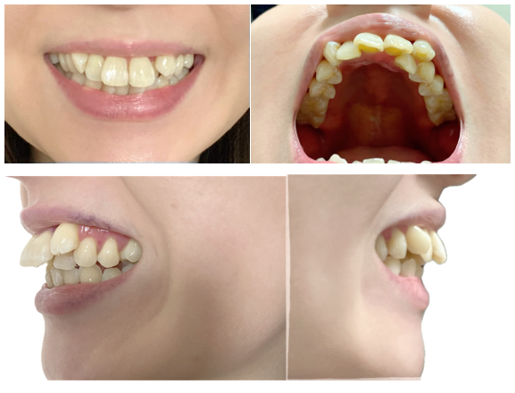 30代からの八重歯矯正